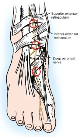numb toes after wearing heels - Deep peroneal nerve entrapment