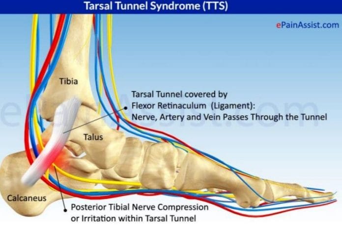numb toes after wearing heels - Tarsal tunnel syndrome